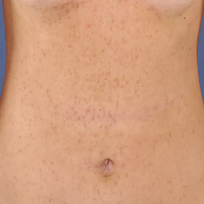 Wysypka na brzuchu choroba Dariera