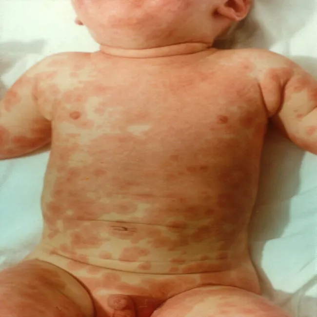 Wysypka na brzuchu u dziecka choroba Kawasakiego 