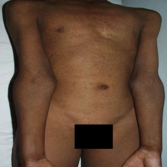 Wysypka na ciele u mężczyzny choroba Dariera