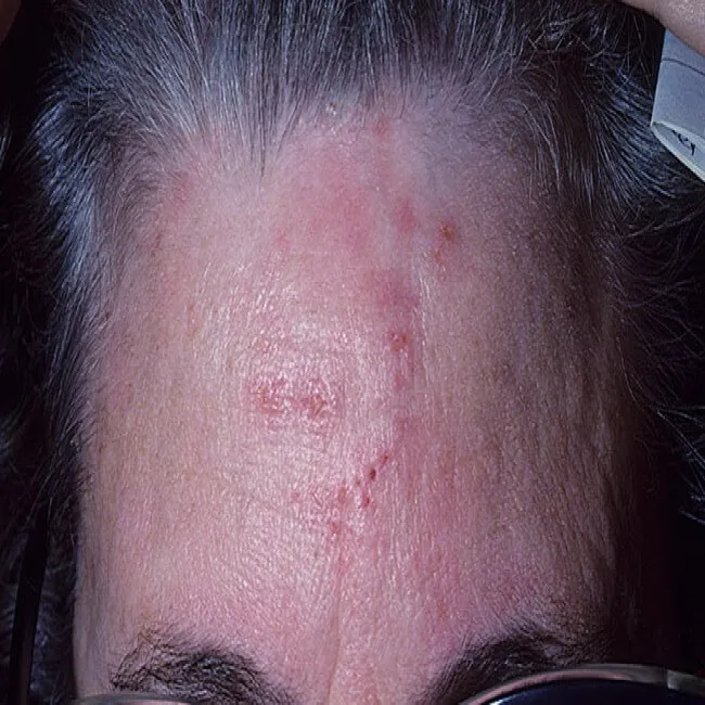 Wysypka na czole opryszczkowate zapalenie skóry 