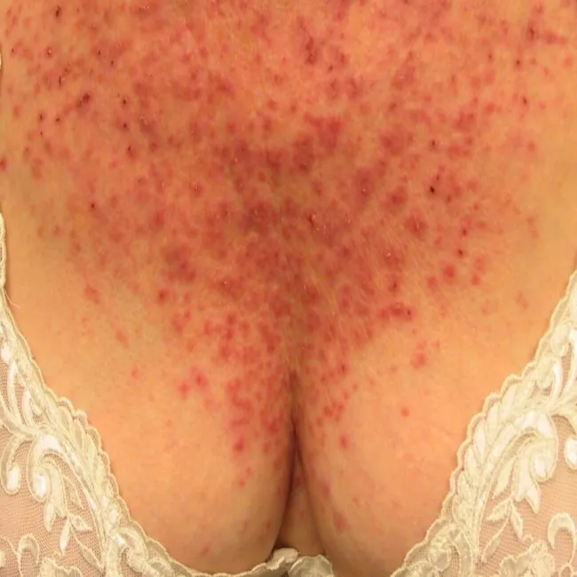 Wysypka na dekolcie choroba Dariera