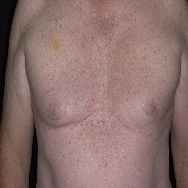 Wysypka na klatce piersiowej choroba Grovera