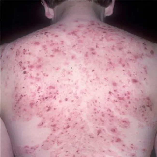 Wysypka na plecach choroba Duhringa 