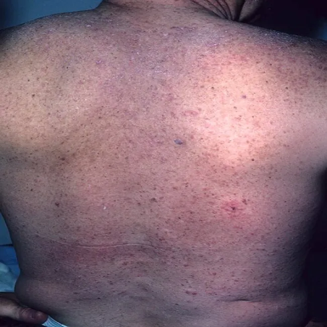 Wysypka na plecach choroba Grovera