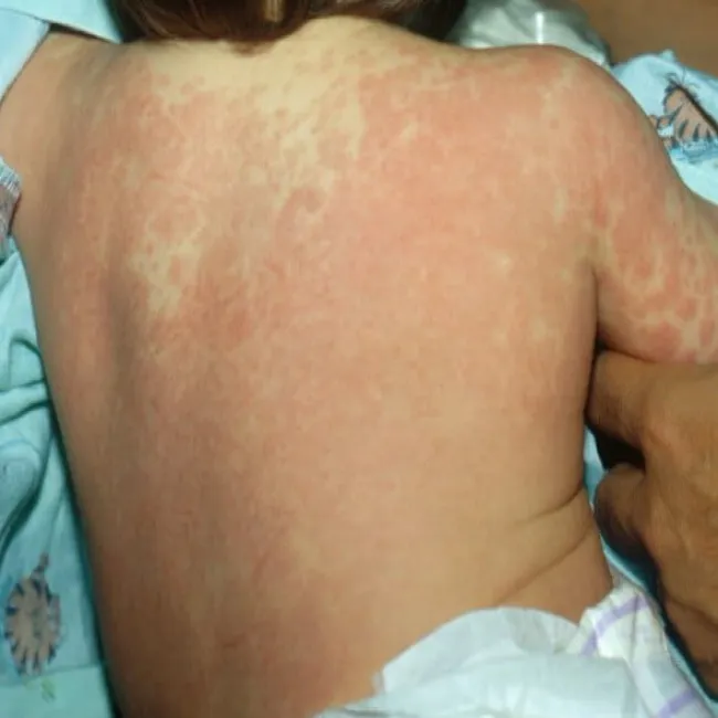 Wysypka na plecach u dziecka choroba Kawasaki