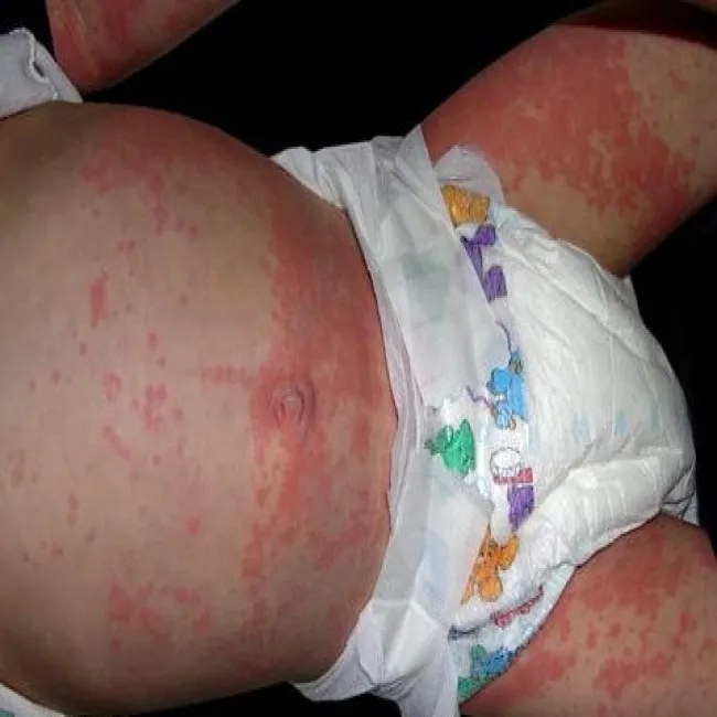 Wysypka na skórze u dziecka choroba Kawasaki