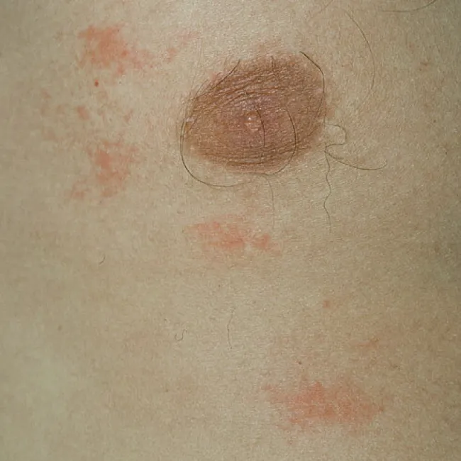 Wysypka na skórze u trenujących pokrzywka cholinergiczna 