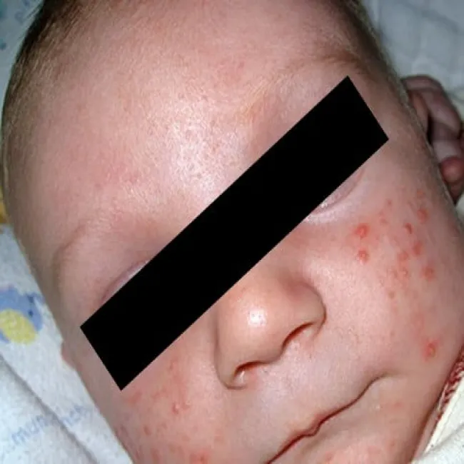 wysypka na twarzy szkarlatyna