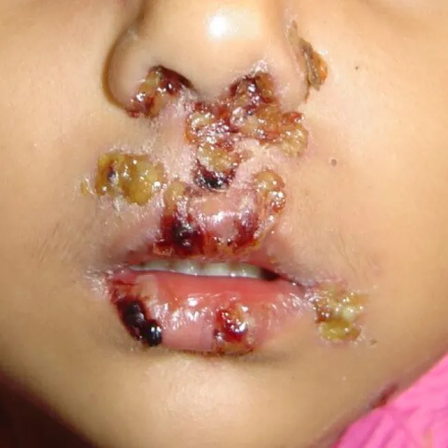 Wysypka pęcherzykowa liszajec zakaźny