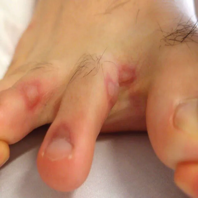 Wysypka pęcherzykowata na stopach