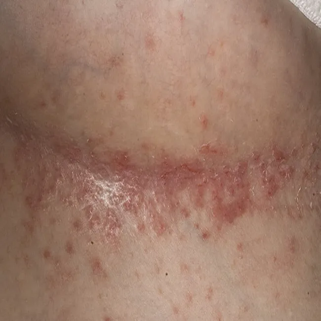 Wysypka pod piersiami choroba Dariera