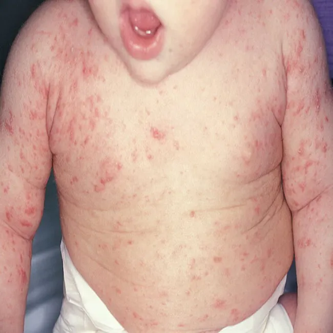 Wysypka u dziecka na skórze choroba świerzb