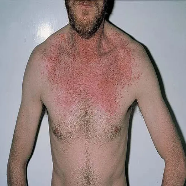 Wysypka u mężczyzn choroba Dariera