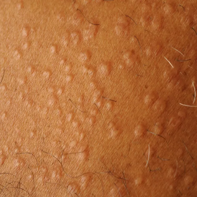 Wysypka w postaci grudek na skórze ziarniniak obrączkowaty 