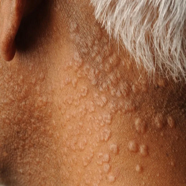 Wysypka w postaci grudek na szyi ziarniniak obrączkowaty 