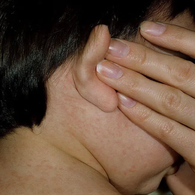 Wysypka za uchem rumień zakaźny