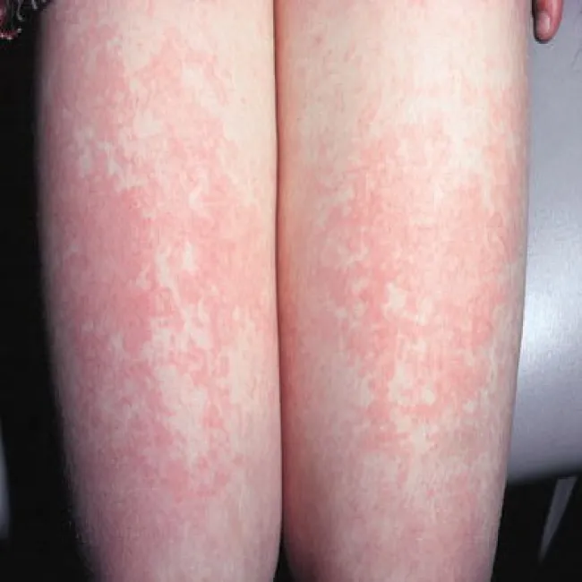 Wysypkowa choroba zakaźna na nogach