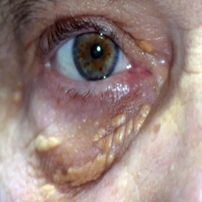 Złogi cholesterolowe pod oczami żółtaki 