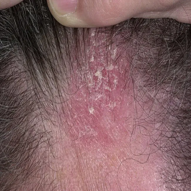 Złuszczanie się skóry i swędzenie głowy 