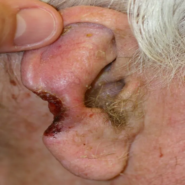 Zaawansowany rak podstawnokomórkowy