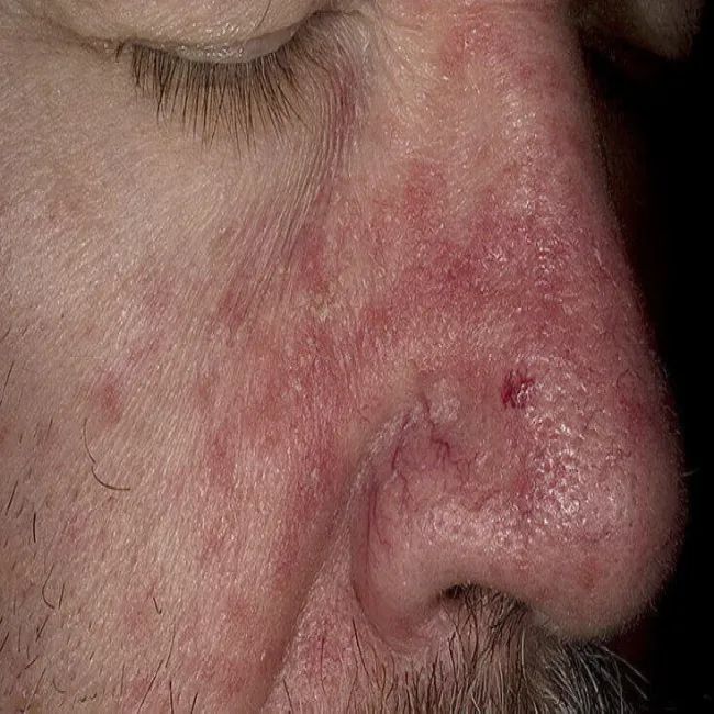 Zaczerwienienie i łuszczenie skóry wokół nosa 