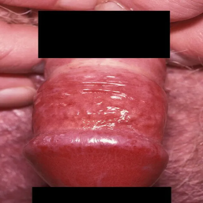 Zaczerwienienie napletka i swędzenie zapalenie napletka