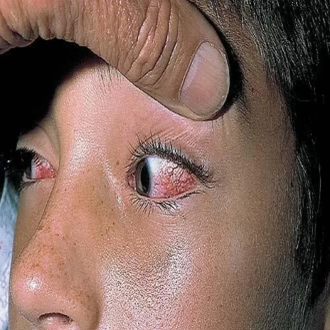 Zaczerwienione spojówki u dziecka choroba Kawasaki