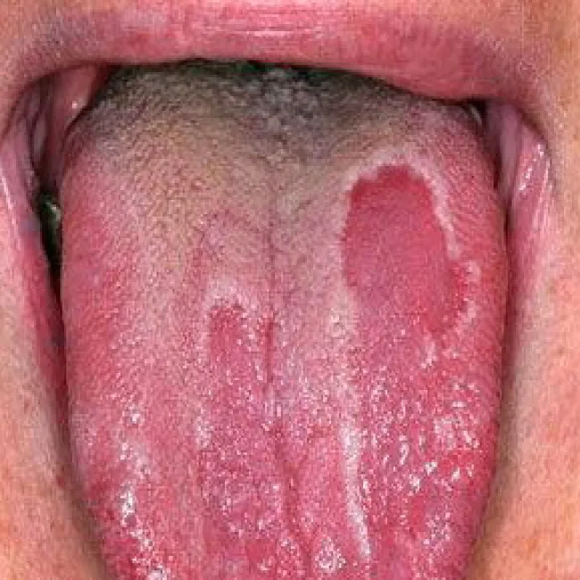 Zaokrąglone plamy na języku