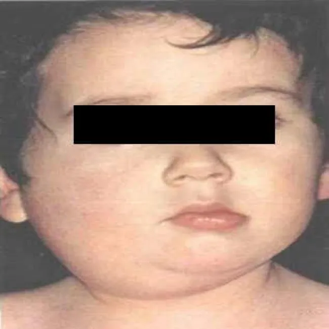 Zapalenie ślinianki podjęzykowej świnka