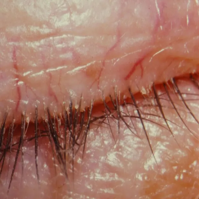 Zapalenie brzegów powiek