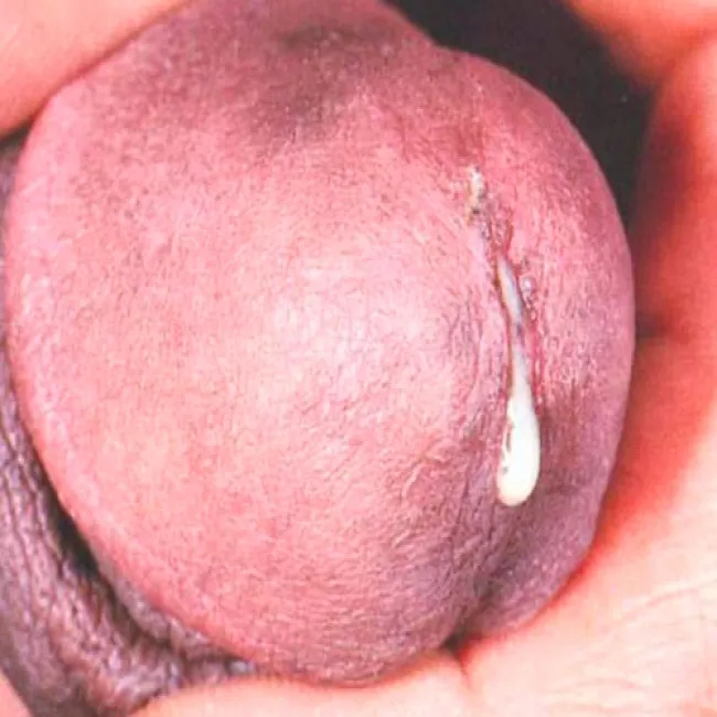 Zapalenie cewki moczowej u mężczyzny z wyraźną lub lekko mętną wydzieliną