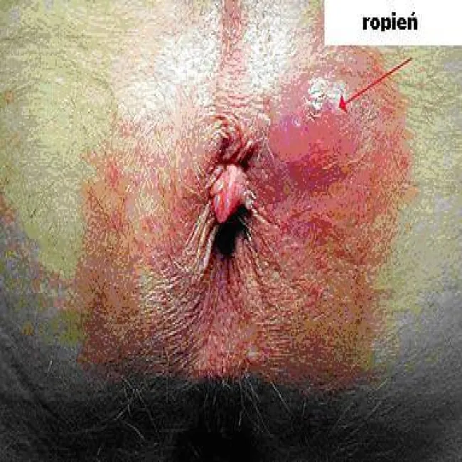 Zapalenie gruczołów apokrynowych skóry okolicy odbytu