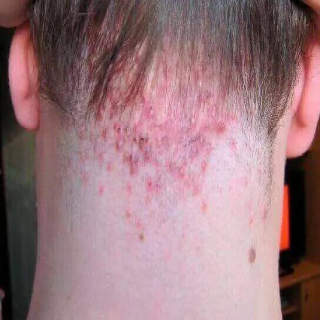 Zapalenie mieszków włosowych na karku szyi