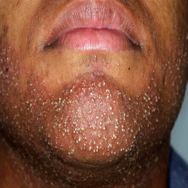 Zapalenie mieszków włosowych u mężczyzny twarz broda