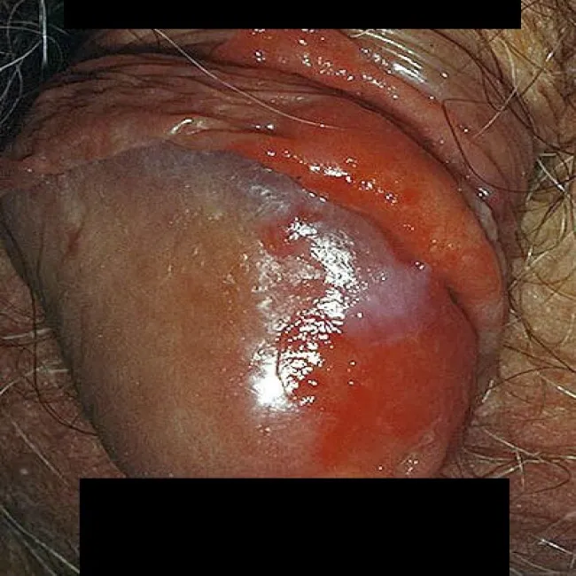 Zapalenie napletka erytroplazja Queyrata