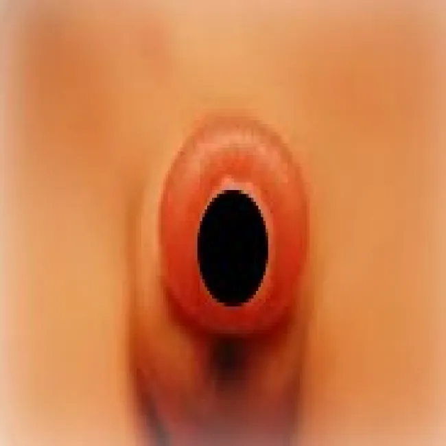 Zapalenie napletka u dzieci załupek