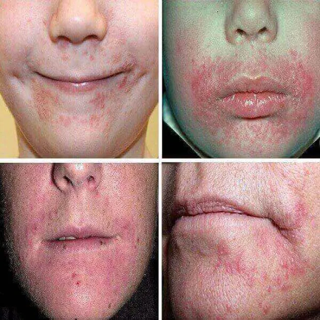 Zapalenie okołoustne objawy