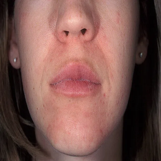 Zapalenie okołoustne zdjęcie