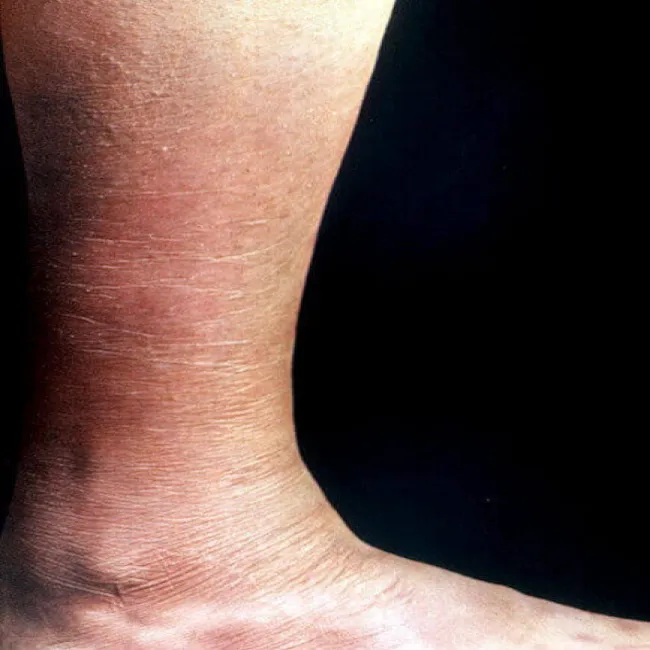 Zapalenie skóry pelagra