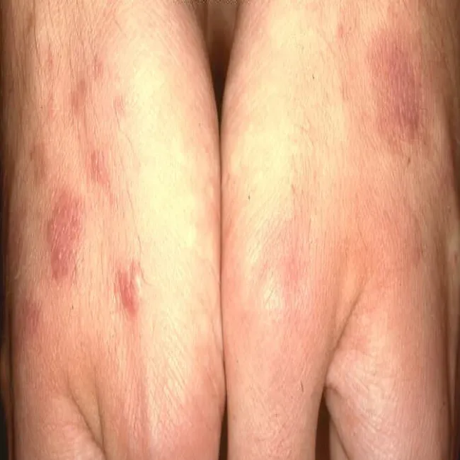 Zapalenie skóry wyprysk mikrobowy