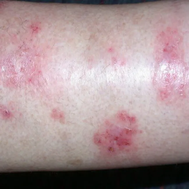 Zapalenie skóry wyprysk pieniążkowy