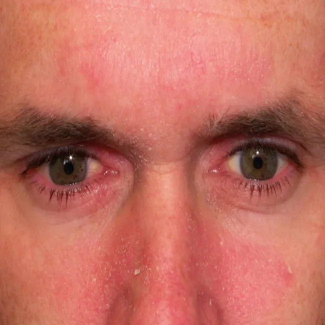 Zapalenie skóry z zaczerwienieniem i łuszczeniem 