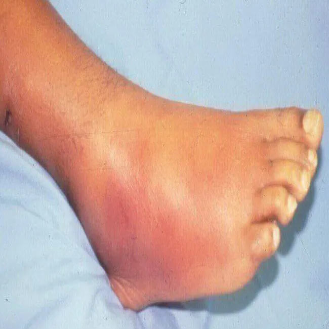 Zapalenie tkanki tłuszczowej na stopie