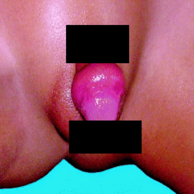 Zasinione okolice penisa u dziecka