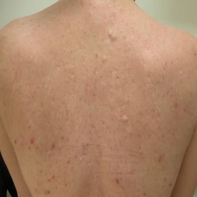 Zaskórniki na plecach od palenia tytoniu