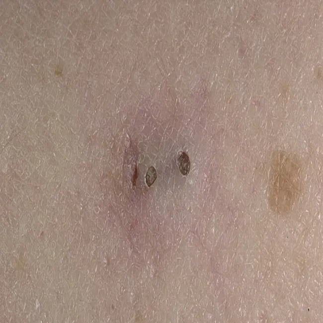 Zaskórniki otwarte na skórze