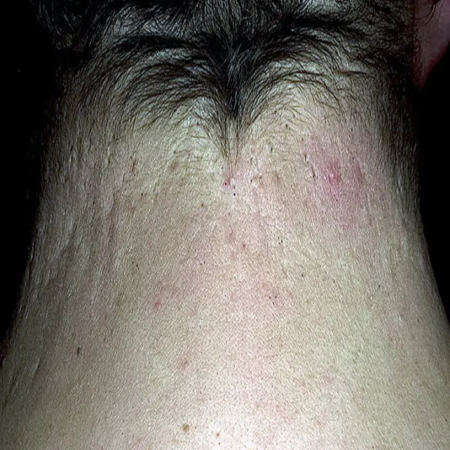 Zaskórniki otwarte na szyi