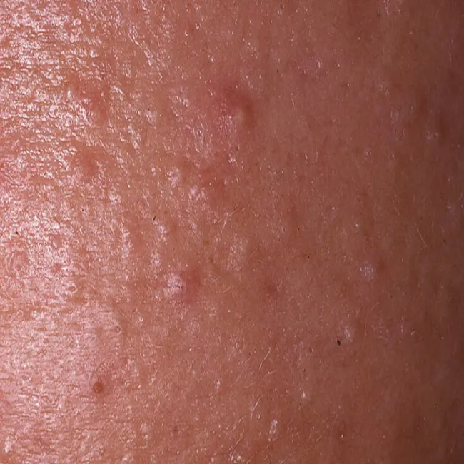 Zaskórniki zamknięte na skórze wygląd