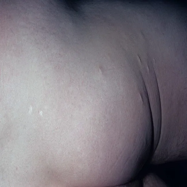 Zdjęcia chorób skóry - Anetoderma 