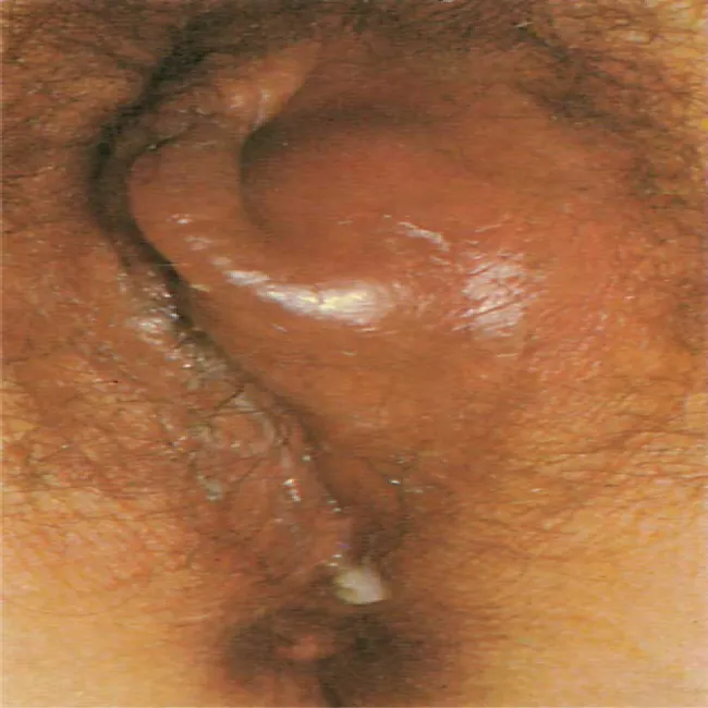 Zdjęcia chorób wenerycznych u kobiet rzeżączka